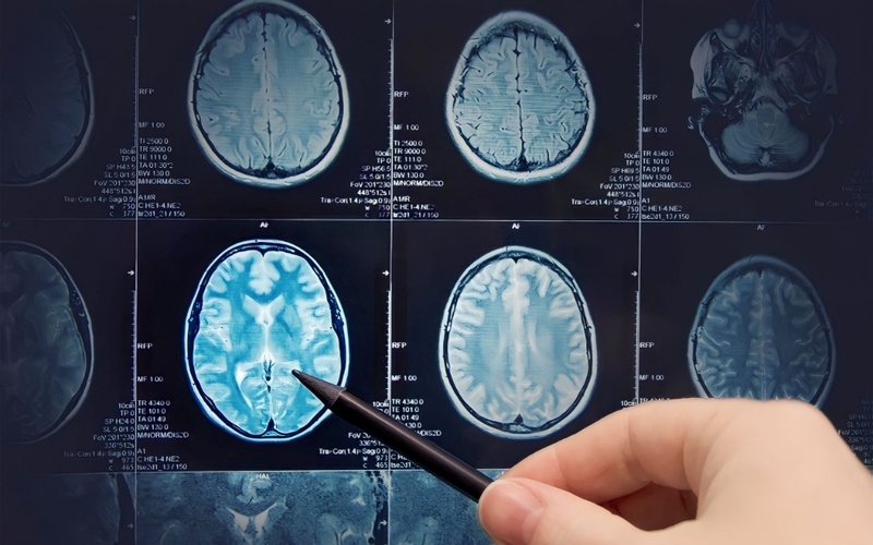 Góc giải đáp: Đau đầu kéo dài có cần chụp cộng hưởng từ não không? 3