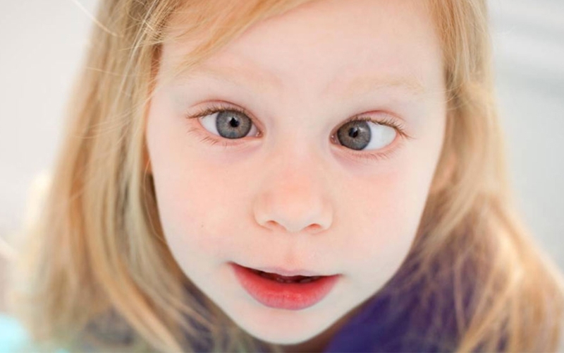 Góc giải đáp: Mắt lác có chữa được không? 1