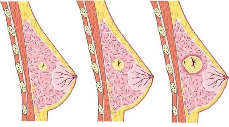 Góc giải đáp: mổ bướu sợi tuyến bao lâu lành?-1
