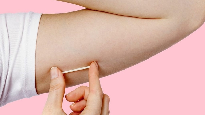 Góc giải đáp: Sinh xong bao lâu thì cấy que tránh thai được? 1