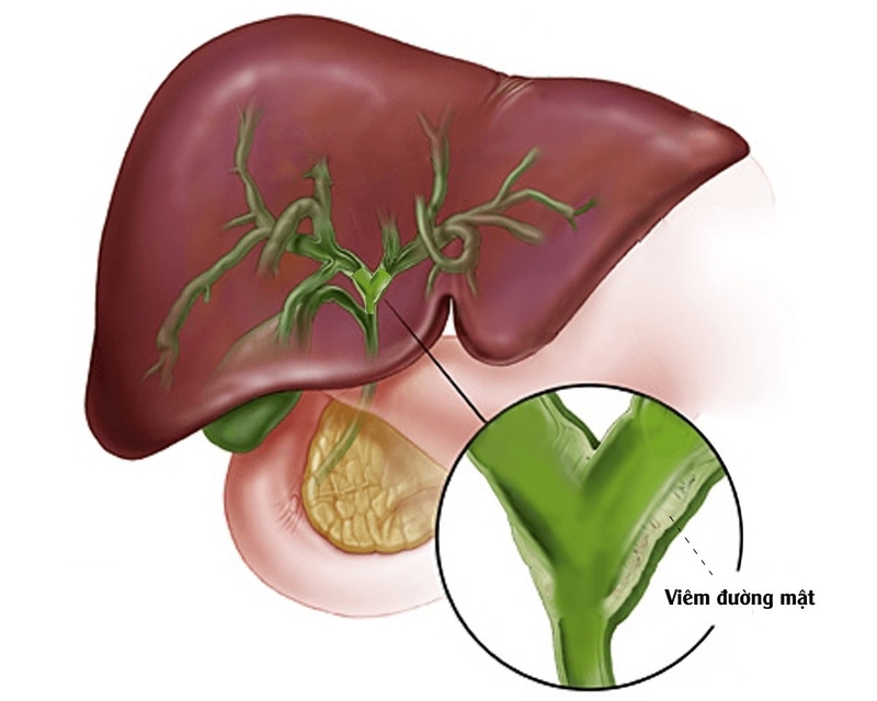 Góc giải đáp: Sỏi túi mật 22mm có phải mổ không? Vì sao? 1