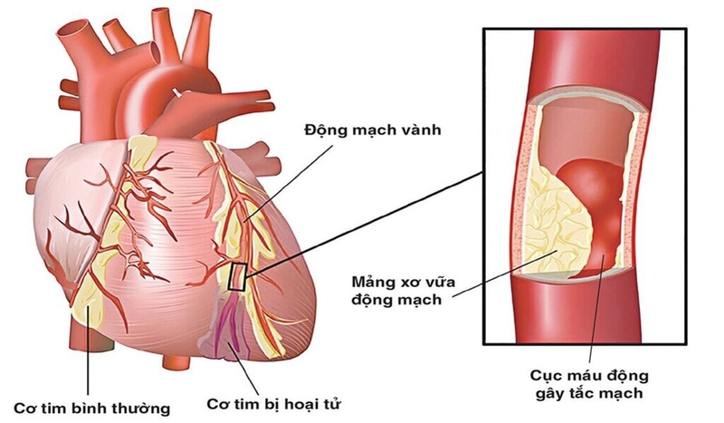 Góc giải đáp: Tại sao việc tầm soát xơ vữa mạch máu rất quan trọng? 3