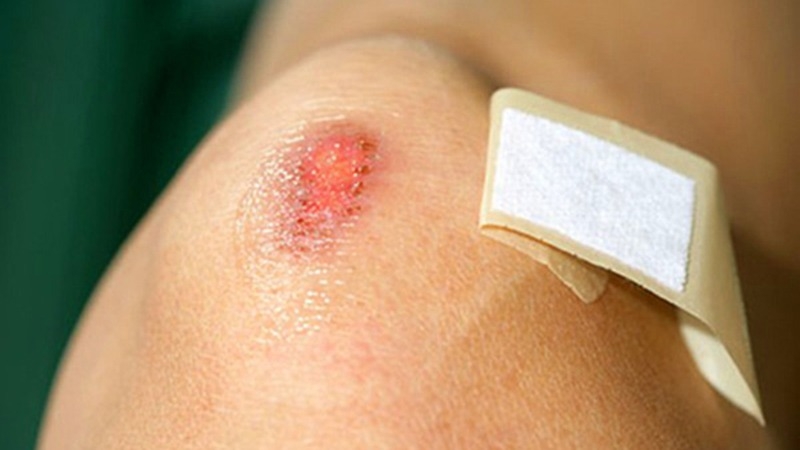 Góc giải đáp thắc mắc: Hiruscar trị sẹo có tốt không? 3