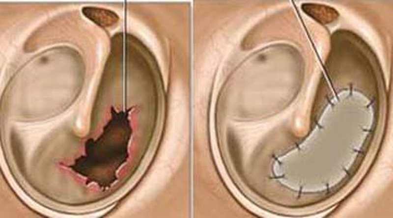 Góc giải đáp: thủng màng nhĩ có nguy hiểm không? 4