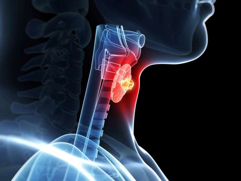Góc giải đáp: Ung thư tuyến giáp thể nhú có mấy giai đoạn tiến triển? 2