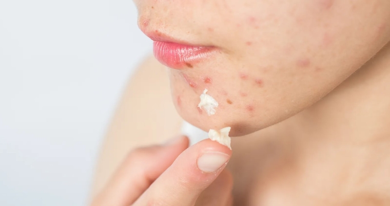 Góc giải đáp: Uống cà phê có nổi mụn không? 2