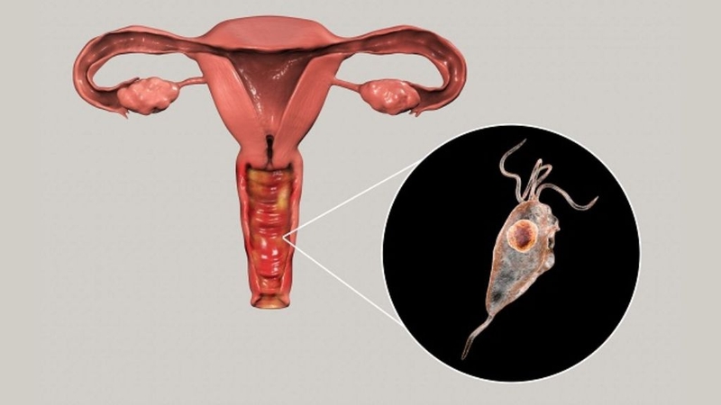 Góc giải đáp: Viêm âm đạo có nguy hiểm không? 1