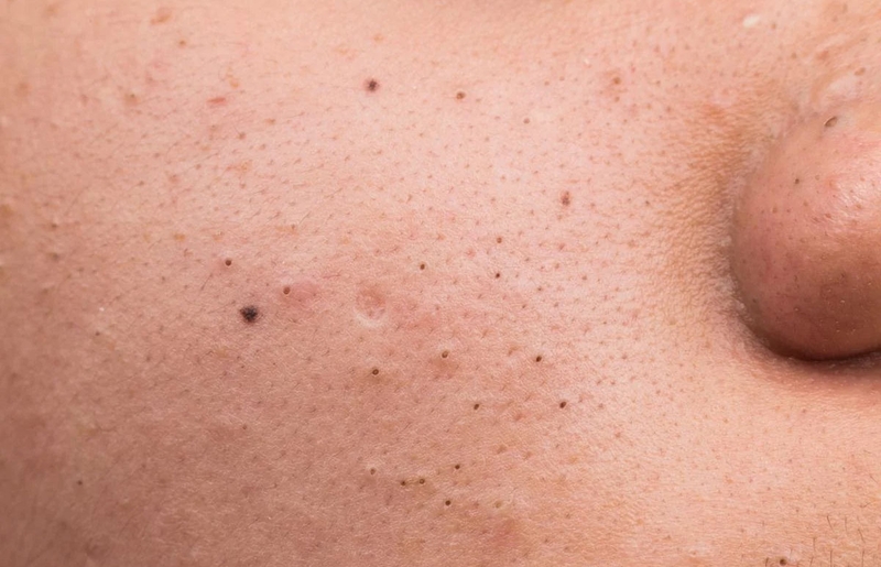 Góc hỏi đáp: Mụn đầu đen để lâu có sao không? 1