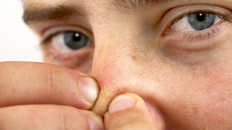 Góc hỏi đáp: Mụn đầu đen để lâu có sao không? 2