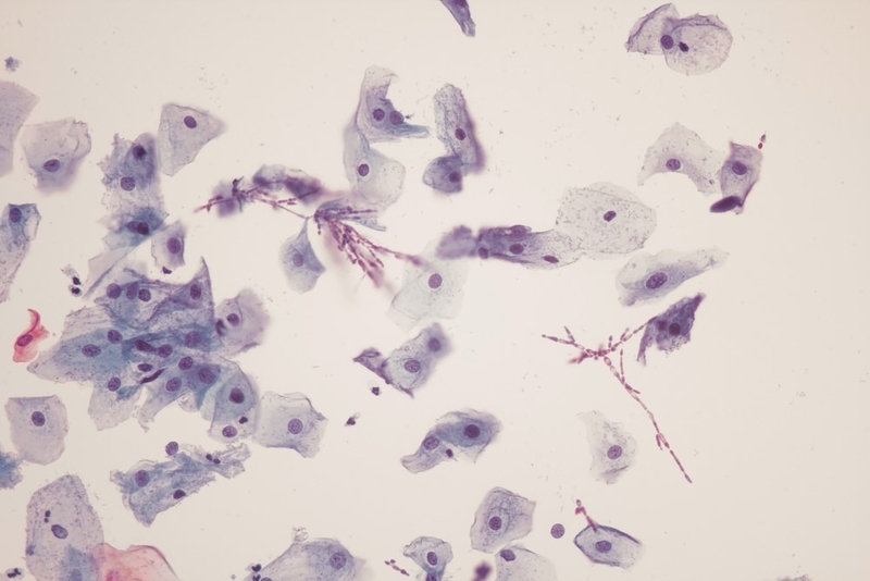 Góc hỏi đáp: Bệnh nấm ống tai có nguy hiểm không? 2