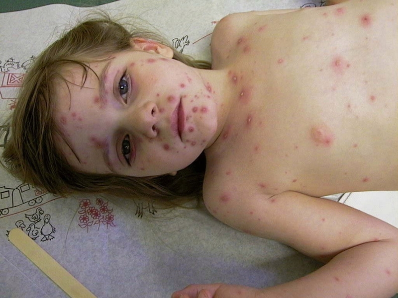 Góc hỏi và đáp: Nốt thuỷ đậu khô lại thì đã lành bệnh chưa? 1