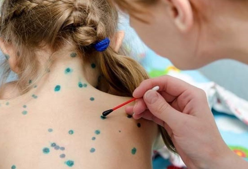 Góc hỏi và đáp: Nốt thuỷ đậu khô lại thì đã lành bệnh chưa? 3