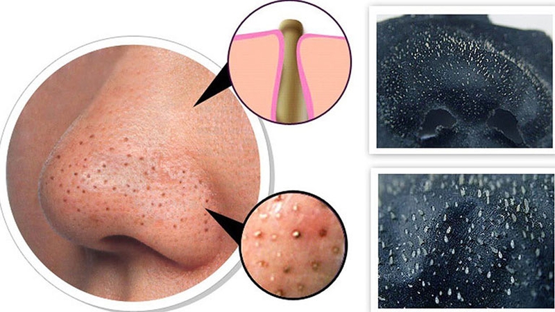 Góc làm đẹp: Chúng ta nên lột mụn sau bước nào?2