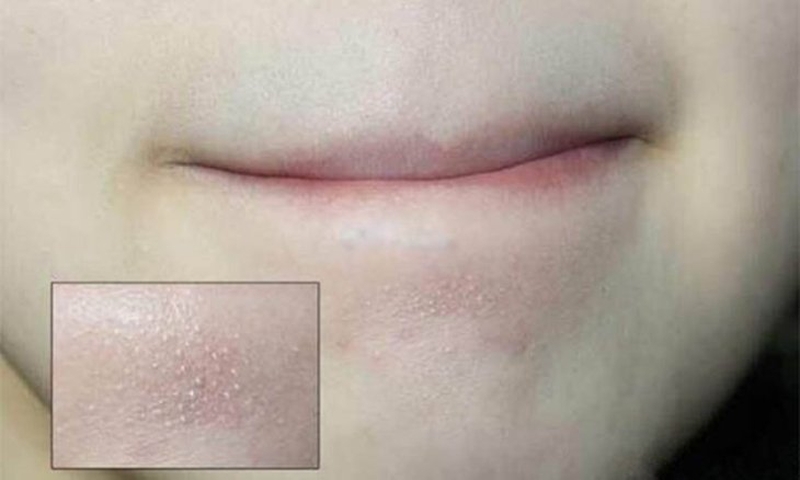 Điều trị mụn ẩn dưới cằm