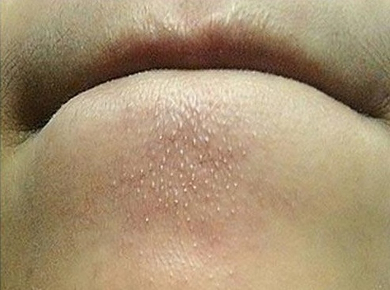 Nguyên nhân gây mụn ẩn dưới cằm