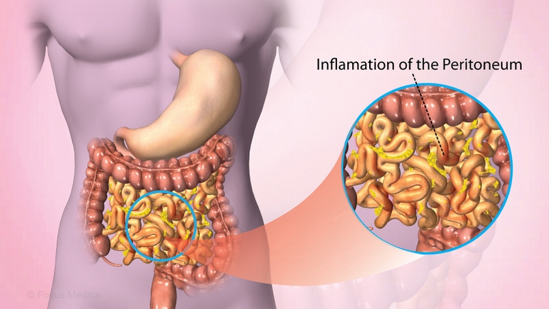 Góc sức khỏe: Các biến chứng của áp xe gan không phải ai cũng biết 2
