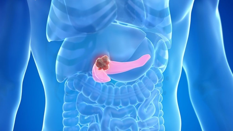 Góc sức khỏe: Sỏi tuyến tụy và những điều cần biết 2