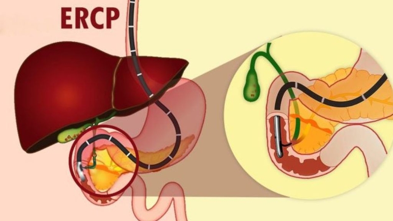 Góc sức khỏe: Sỏi tuyến tụy và những điều cần biết 3