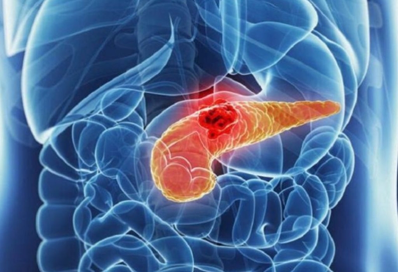 Góc sức khoẻ: Thông tin từ A đến Z về bệnh sỏi tuỵ 2