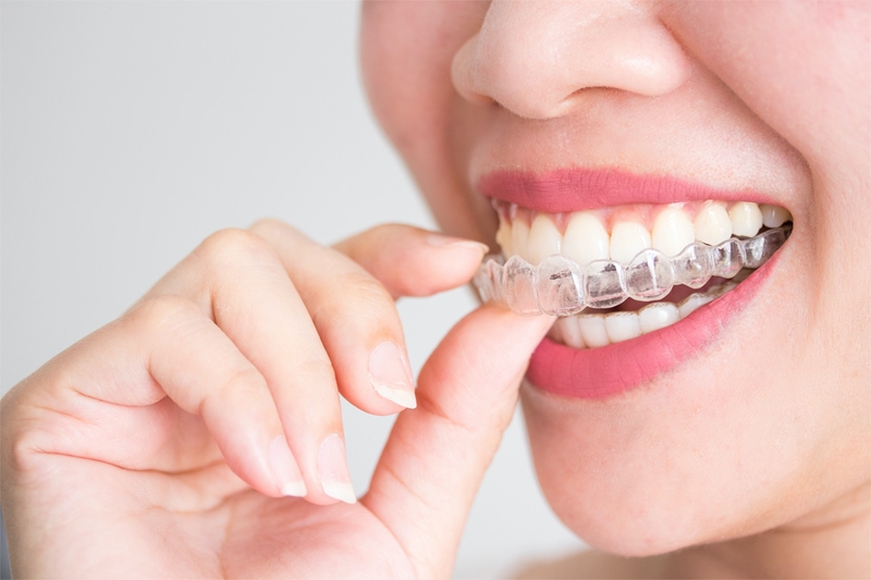 Niềng răng invisalign có hiệu quả không? Ưu và nhược điểm 1