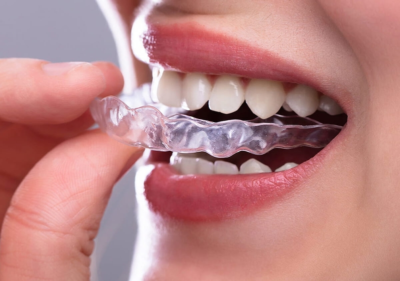 Niềng răng invisalign có hiệu quả không? Ưu và nhược điểm 3
