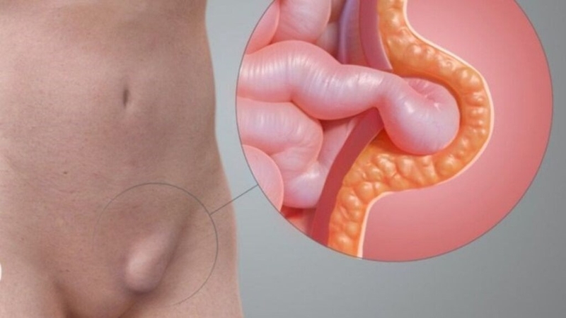 goc-thac-mac-phau-thuat-thoat-vi-thanh-bung-la-gi 1.jpg