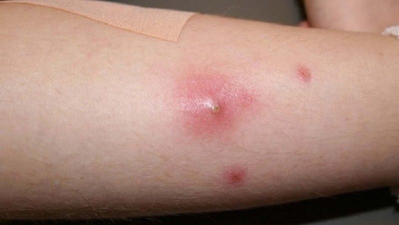 Giải đáp: Bị mụn nhọt không nên ăn gì?