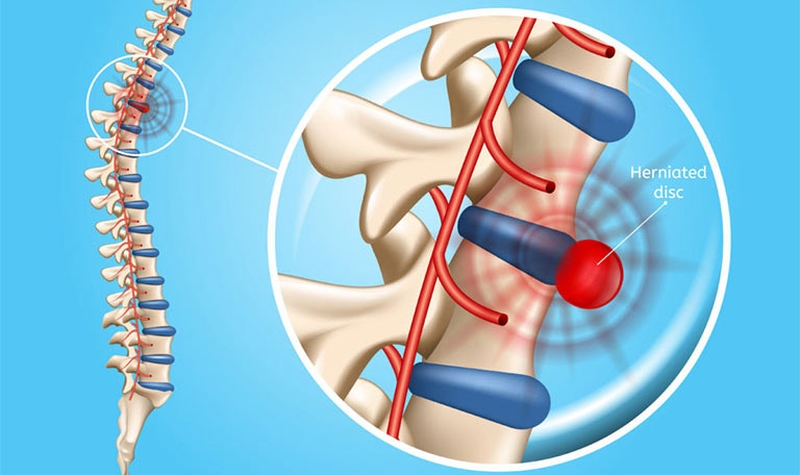 Thăm khám bác sĩ để điều trị thoát vị đĩa đệm sớm nhất