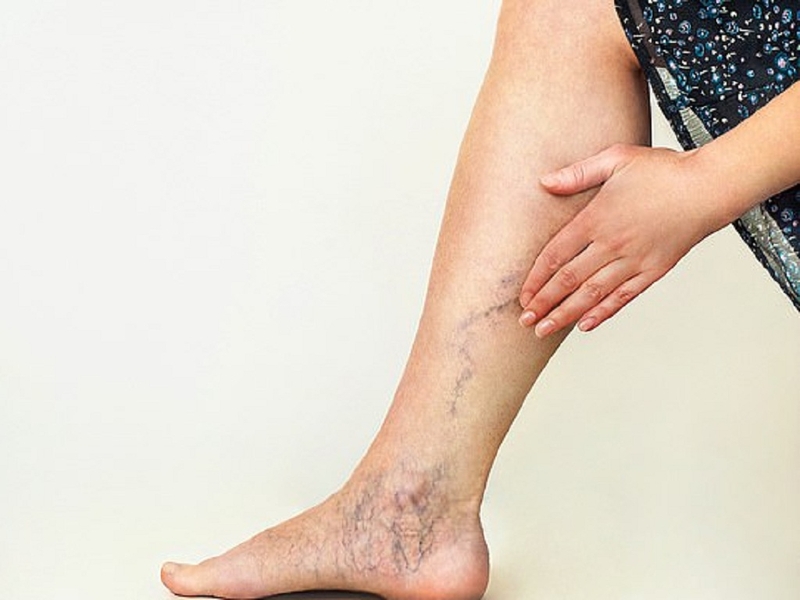 Gợi ý 6 bài tập giãn tĩnh mạch chân đơn giản tại nhà 1