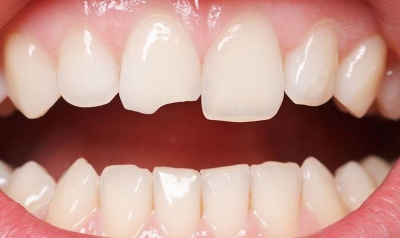 Gợi ý cách phục hồi răng bị mẻ tại nhà nhanh chóng 1