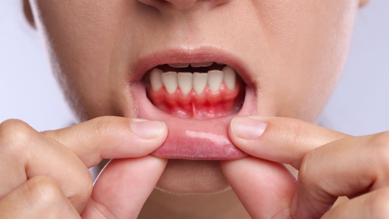 Gôm mềm là dấu hiệu của bệnh gì?