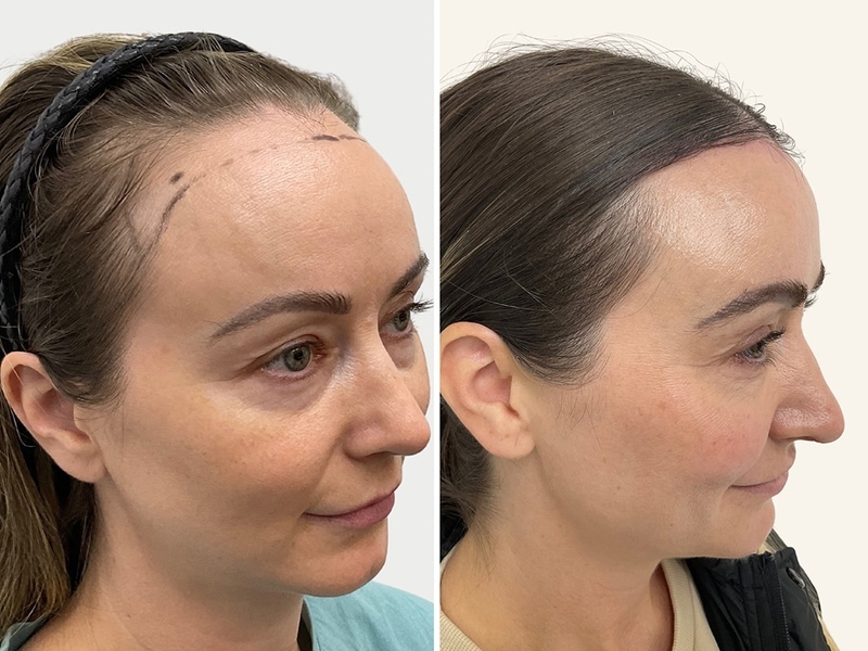 Hạ đường chân tóc là gì? Có nên hạ đường chân tóc không? 3