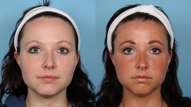 Hạ đường chân tóc là gì? Có nên hạ đường chân tóc không? 1