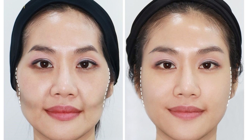 ha-go-ma-la-gi-nhung-dieu-can-biet-va-phau-thuat-ha-go-ma 2