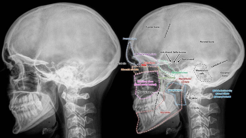 ha-go-ma-la-gi-nhung-dieu-can-biet-va-phau-thuat-ha-go-ma 3