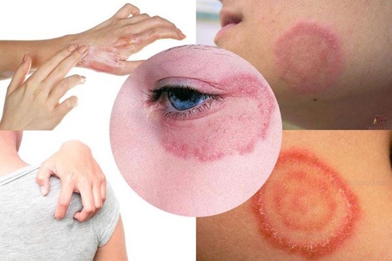 Hắc lào có phải là nấm da không? Vị trí thường xuất hiện ở đâu? Nguyên nhân và cách phòng tránh 2