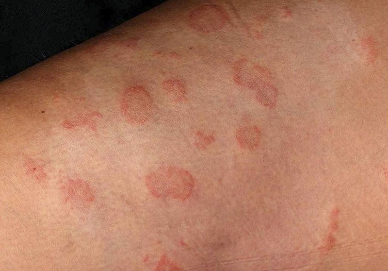 Hắc lào lâu năm có thể chữa khỏi không? 2