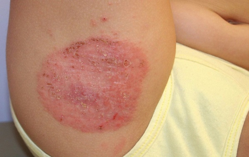 Hắc lào lây không? Bệnh hắc lào có chấm dứt vĩnh viễn không? 2