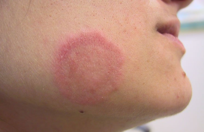 Hắc lào lây không? Bệnh hắc lào có chấm dứt vĩnh viễn không? 1