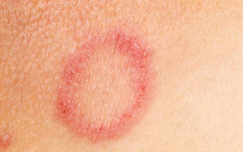 Hắc lào sau gáy có nguy hiểm không? Cách chữa hắc lào tại nhà 1