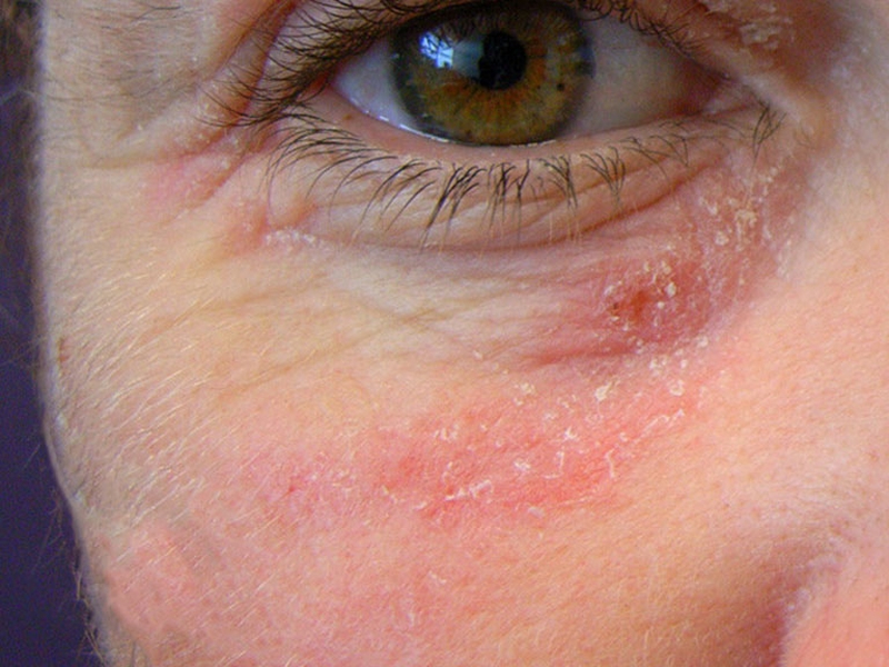 Hắc lào và chàm có liên quan đến nhau không? 2