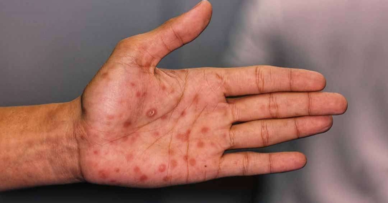 Hắc lào và giang mai khác nhau như thế nào? 2