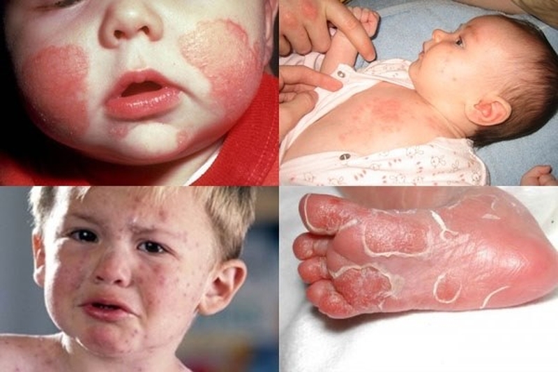 Hắc lào và giang mai khác nhau như thế nào? 3