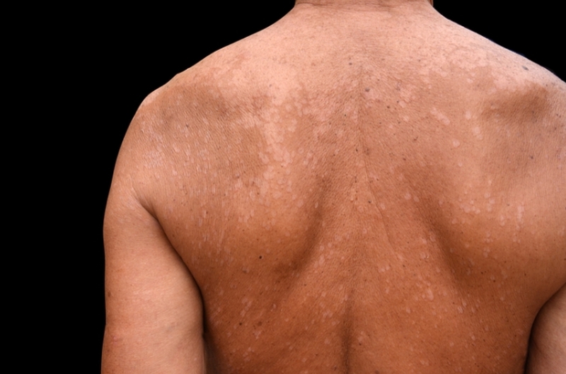 Hắc lào và giang mai khác nhau như thế nào? 1