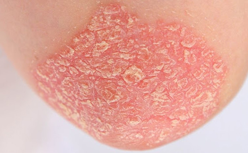 Hắc lào vảy nến phân biệt như thế nào? Điều trị có khó không? 2