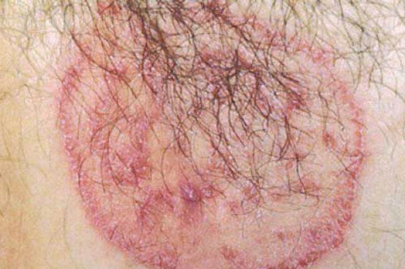 Hắc lào vùng kín nam có nguy hiểm không? Thuốc điều trị hắc lào nhanh chóng 1