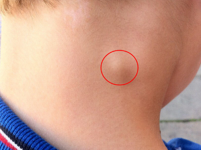 benh-lao-hach-co-nguy-hiem-khong-3