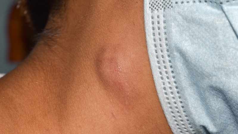 Sưng hạch bạch huyết (nổi hạch) là phản ứng thường gặp khi hệ miễn dịch hoạt động mạnh để chống lại tác nhân lạ