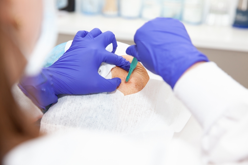 Sinh thiết là phương pháp tối ưu để phân biệt hạch lành tính hay ác tính