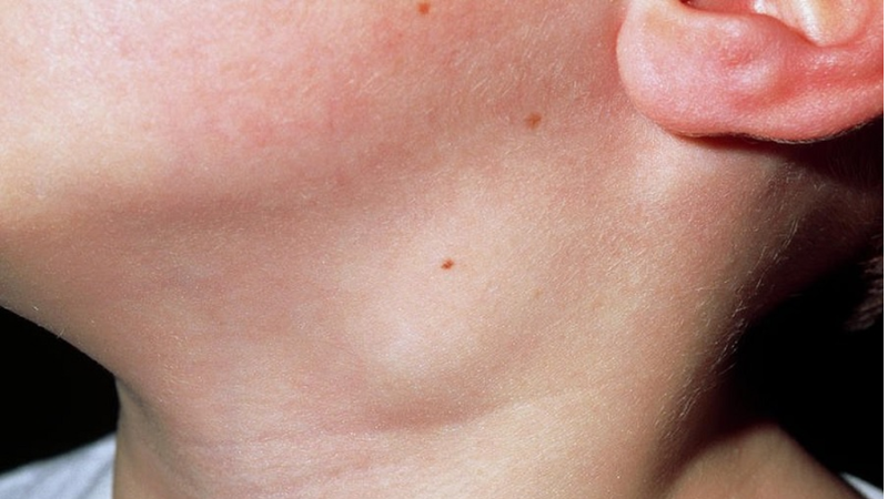 hach-co-ron-co-nguy-hiem-khong-hieu-biet-ve-hach-co-ron 1